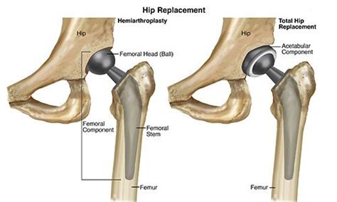 total hip arthroscopy chanel boyer|total hip arthroplasty reviews.